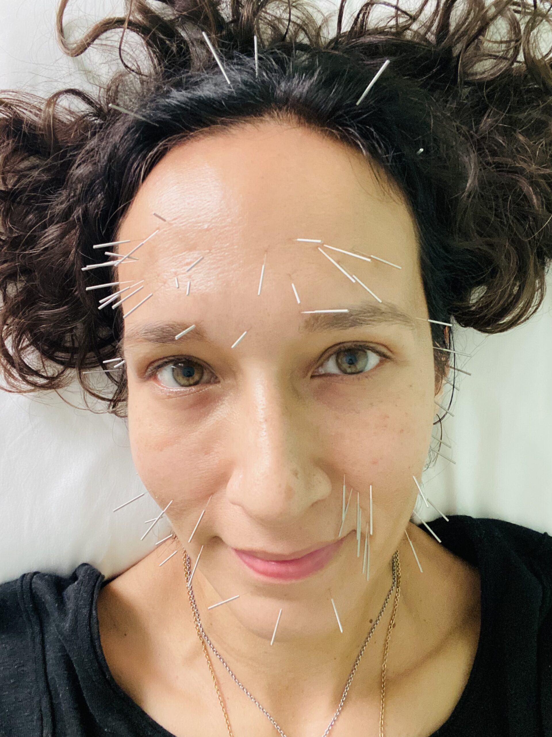 Facial acupuncture in El Paso