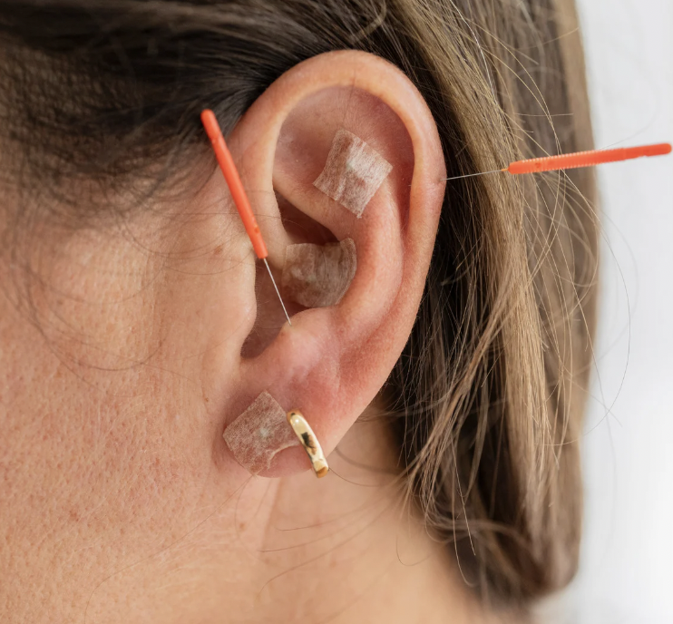 Ear Acupuncture in El Paso: How Auricular Therapy Supports Whole-Body Healing